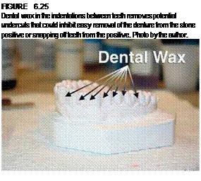 Подпись: FIGURE 6.25 Dental wax in the indentations between teeth removes potential undercuts that could inhibit easy removal of the denture from the stone positive or snapping off teeth from the positive. Photo by the author. 
